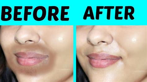 Remove Dark Patches Around Mouth Area 100 Effective Tanutalks