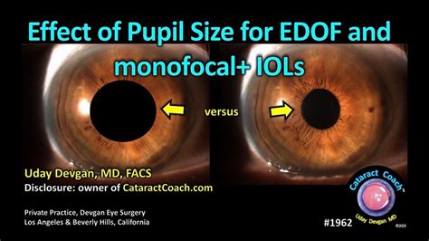 CataractCoach Effect Of Pupil Size For EDOF IOLs Extended Depth Of Focus YouTube