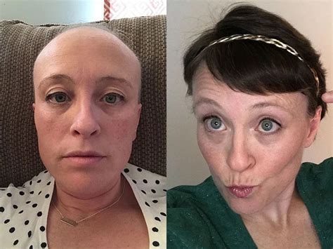 Chemo Curl Haircut Styles Dare To Bare Your Chemo Hair Loss Chemo