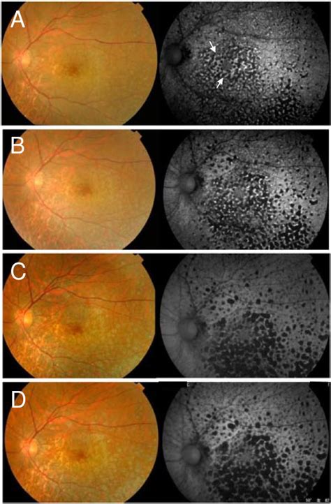 Fundus And Fundus Autofluorescence Faf Findings In The Eye With