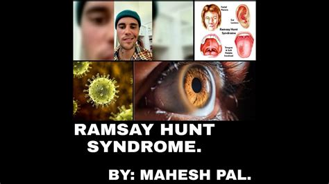 Ramsay Hunt Syndrome Ii Signs And Symptoms Ii Youtube