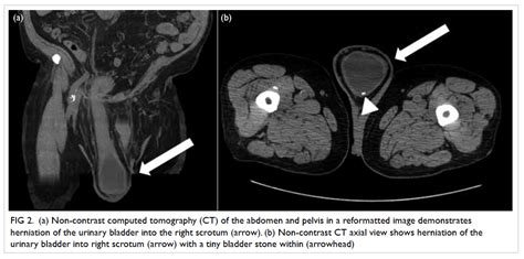 Urinary Bladder Inguinal Hernia An Uncommon Cause Of Scrotal Swelling
