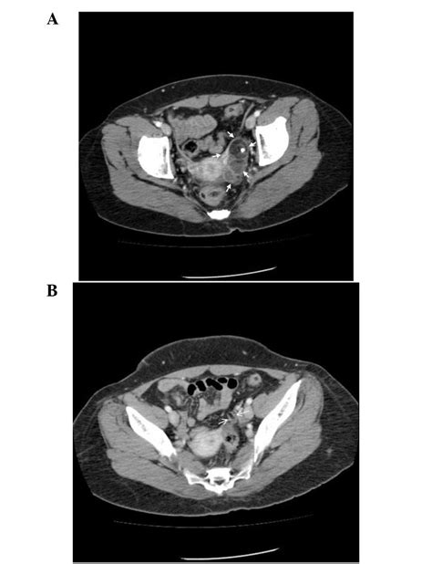 Synchronous Occurrence Of Mature Cystic Teratoma Of The Fallopian Tube