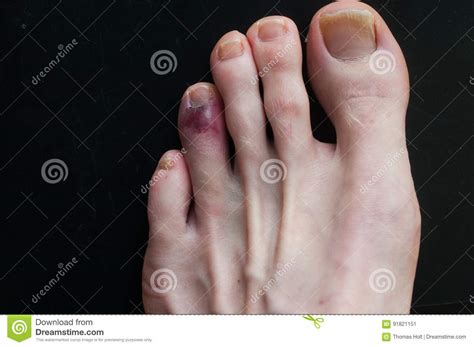 Broken Toe Showing Bruising On Skin Due To Injury Stock