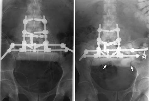 Spinal Pelvic Reconstruction After Total Sacrectomy For En Bloc