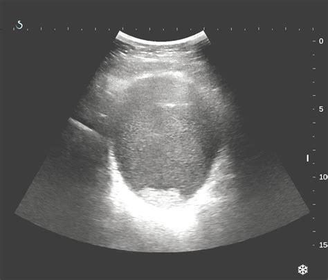 Vietnamese Medic Ultrasound Case 357 Pelvic Mass Dr Phan Thanh HẢi