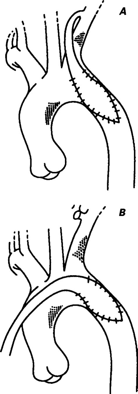 Figure 3 From Left Internal Mammary Artery Flap Aortoplasty Semantic