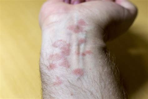 What Does Nummular Eczema Look Like Photos Edison Health
