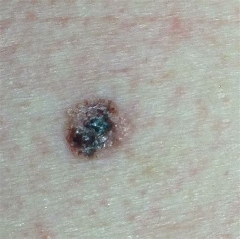 What does a normal mole look like. What Do Cancerous Moles Look Like? - HTQ