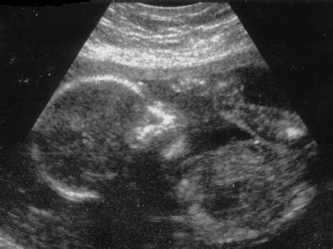 The Lost Girls Pressure Mounts On Government To Curb Use Of Ultrasound Scans To Show Gender Of
