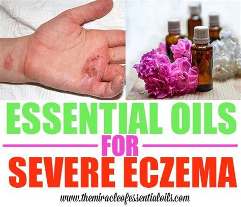 Essential Oils For Severe Eczema Oils For Eczema Essential Oils For