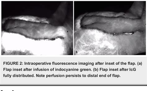 Figure 2 From Indocyanine Green Angiography As The Principal Design And