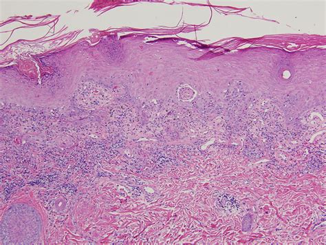 Discoid Lupus Erythematosus Pathology Pathology Outlines Lupus