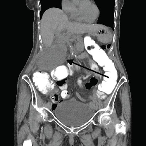 Coronal Nonenhanced Ct Image Showing A Markedly Distended Gallbladder
