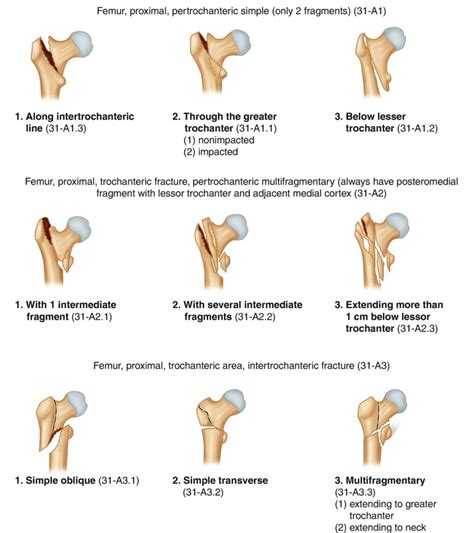 Fig 93 Aoota Classification For Trochanteric Fractures Reproduced