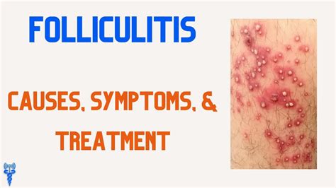 Folliculitis Causes Symptoms Treatments Youtube