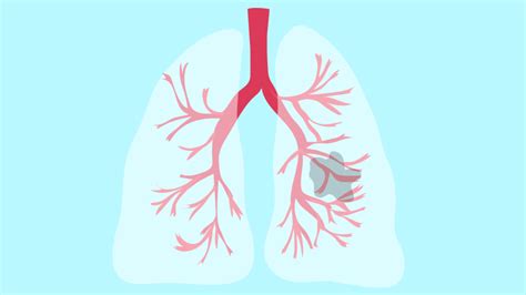 Catching Lung Cancer Early Could Save Your Life Topic Answers