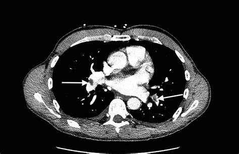 Cureus Acute Pulmonary Embolism In A Healthy Male With Elevated Lipoprotein A