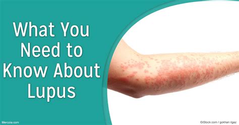 Lupus What You Need To Know About This Disease
