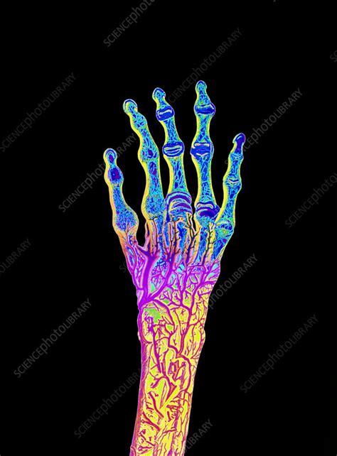 Coloured Illustration Of Blood Supply To Hand Stock Image P2000054