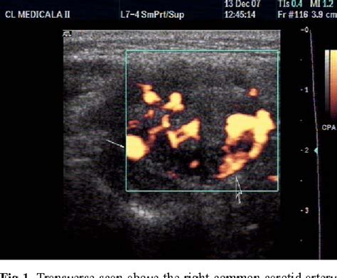 Figure 1 From The Role Of Ultrasonography In The Diagnosis Of Glomic