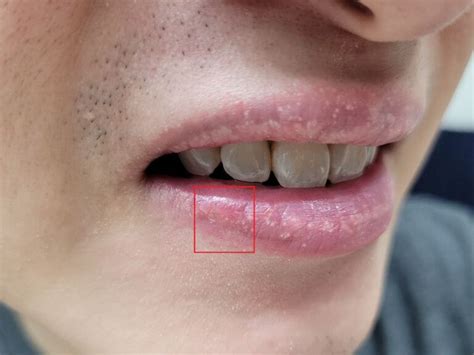 Fordyce Spots On Tongue