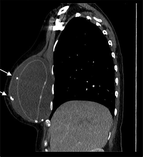 B Contrast Enhanced Sagittal Ct Image Of The Chest Shows The Vp Shunt