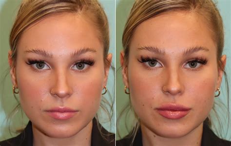 Lip Augmentation Photos Chevy Chase Md Patient 16286
