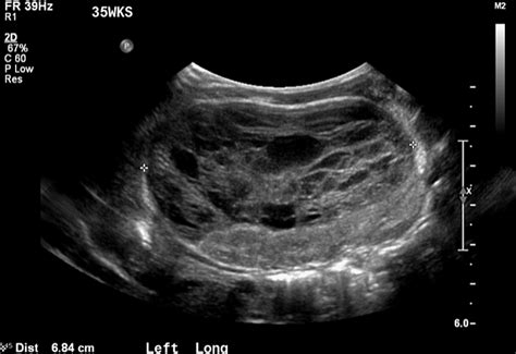 Cureus Renal Protective Urinoma Formation In A Newborn Babe With Posterior Urethral Valves