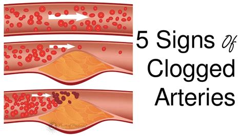 5 Signs Of Clogged Arteries Power Of Positivity Clogged