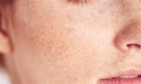 Mole Vs Freckle The Difference Between These Skin Spots Software