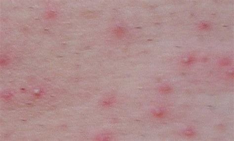 Folliculitis Pictures Symptoms Causes Treatment Hubpages