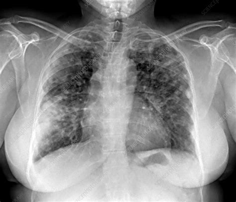 Lung Disease X Ray Stock Image M180 0144 Science Photo Library