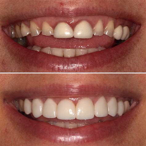 8 Veneers To Cover And Protect Front Teeth While Enhancing The Smile