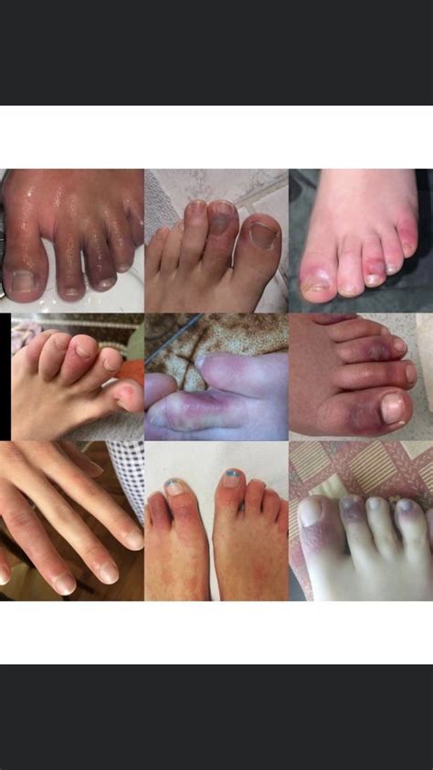 Dermatologists Link Swollen Discolored Toes To Covid 19 Exposure Wcyb