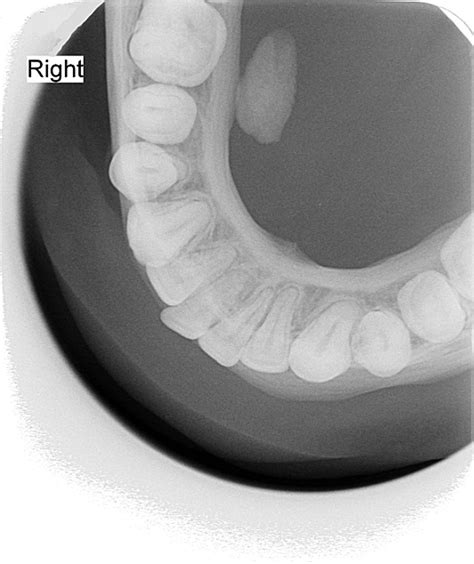 Submandibular Sialolithiasis In A Child Archives Of Disease In Childhood