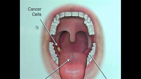 How Do You Know If You Have Throat Cancer From Hpv Hpv Throat Cancer