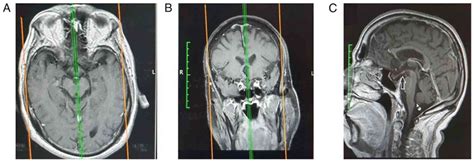 Comparison Of The Endoscopic Endonasal To Microscopic Sublabial