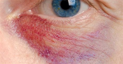 Severe Allergic Reaction Eye Swelling