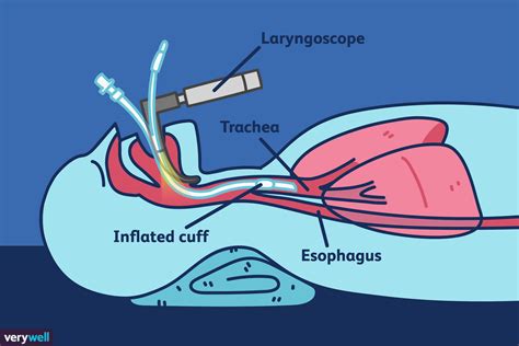 Was ist eine Intubation und warum wird sie durchgeführt