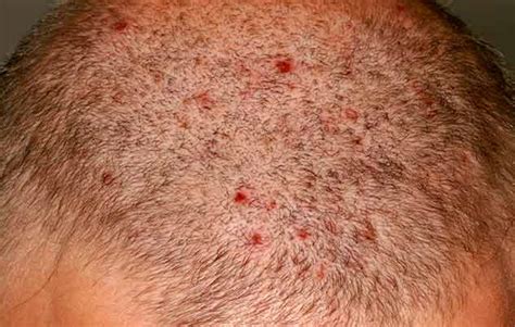 Scalp Folliculitis Causes Symptoms And Treatment In Hindi सिर पर लाल