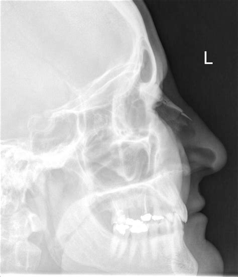 Nasal Fracture X Ray