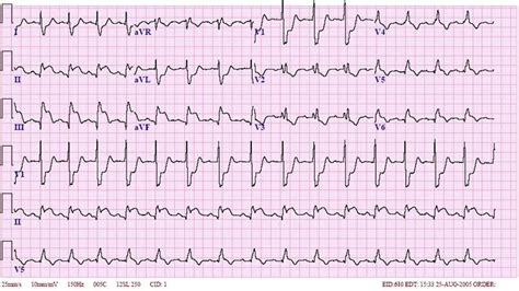 Inferior Wall Mi With Rbbb Ecg Example 2 Learn The Heart