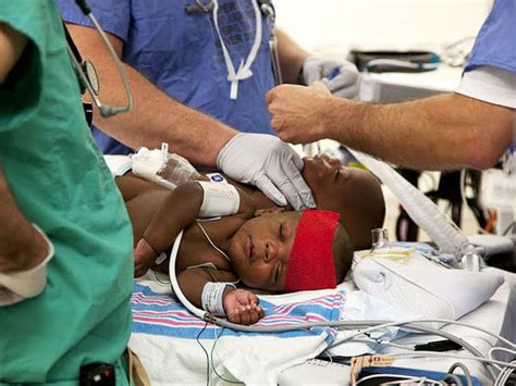 Medical Miracle Conjoined Twins Separated In Memphis Photo 4