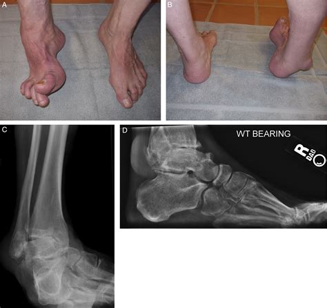 Combined Total Ankle Arthroplasty With Posterior Tibial Tendon Transfer