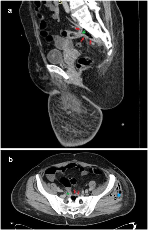 Sagittal A And Axial B Ct Images Of Pelvis And Presacral Region