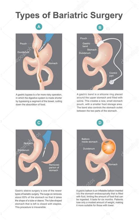 Types Of Bariatric Surgery It Is Process For The Digestive System In