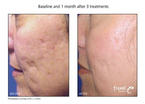 Fraxel Laser For Scar Removal Elite Body And Laser