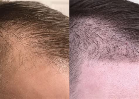 One Year On Finasteride Will It Get Better Photo Wrassmanmd