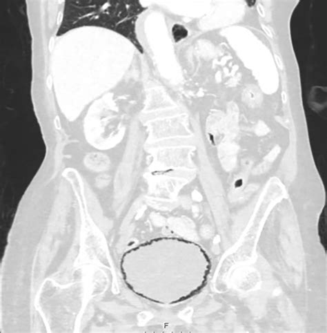 Emphysematous Cystitis A Radiographic Diagnosis Bmj Case Reports